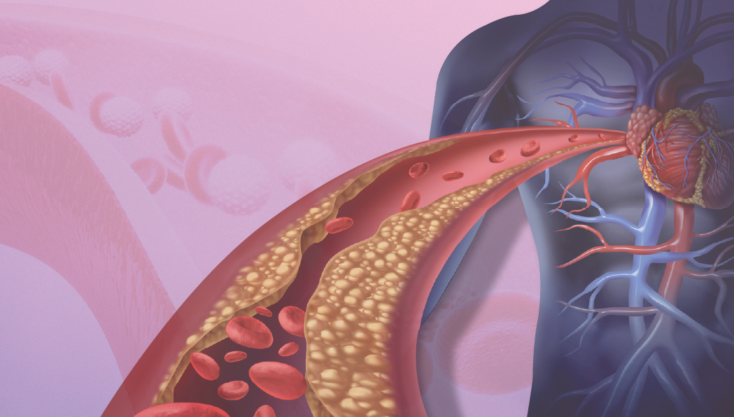 Exploring the Interplay of Diabetes, Atherosclerosis, and Atherothrombosis for Comprehensive Cardiovascular Event Prevention